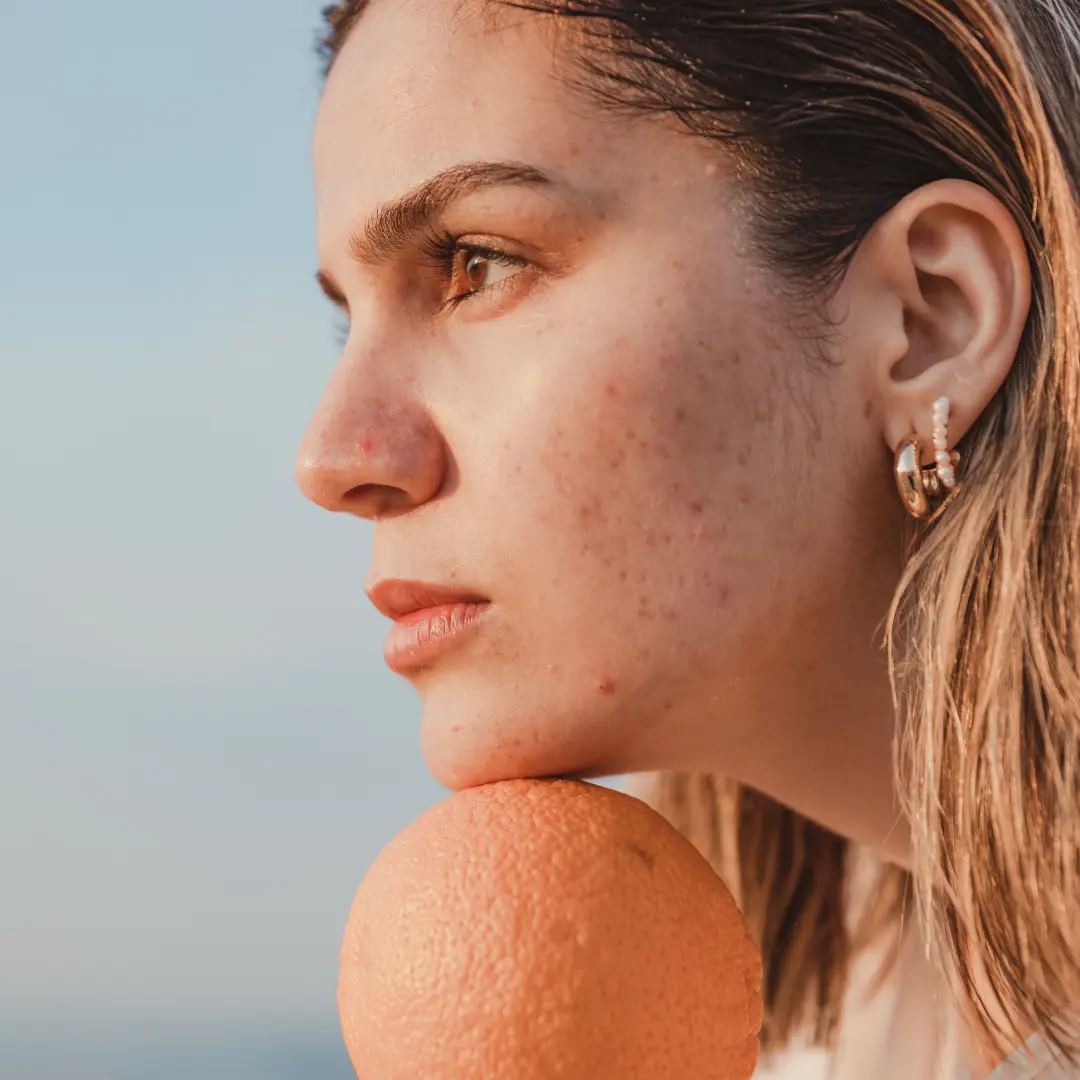 Acne estival o acne de verano