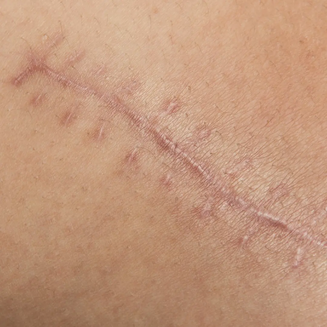 Como quitar cicatrices por dermatologo